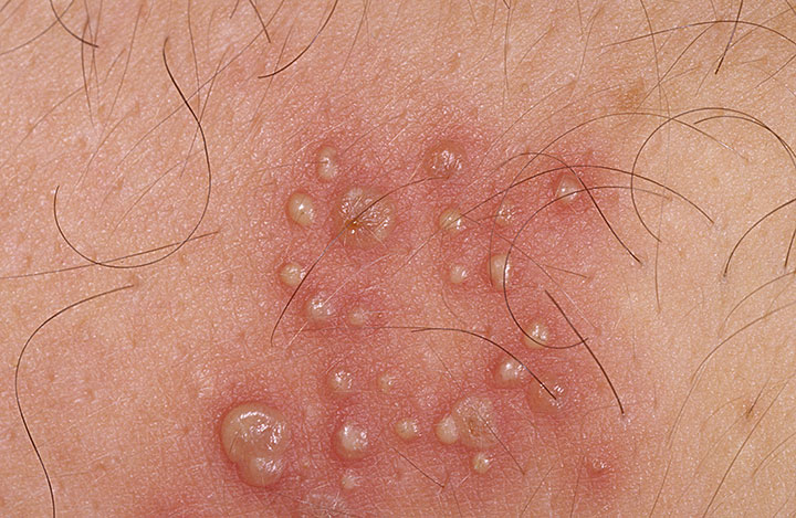 Herpes simplex virus - Wikipedia